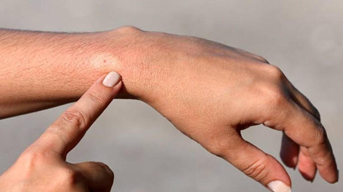Allergische reacties door een bijensteek kunnen dodelijk zijn Bron:İHA Allergoloog Assoc